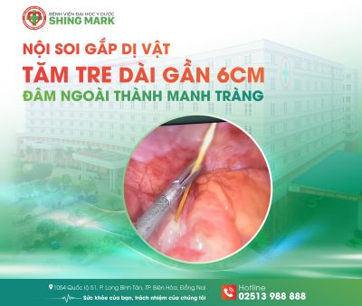 NỘI SOI GẮP DỊ VẬT TĂM TRE DÀI GẦN 6CM ĐÂM NGOÀI THÀNH MANH TRÀNG