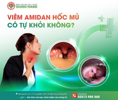 VIÊM AMIDAN HỐC MỦ CÓ TỰ KHỎI KHÔNG?