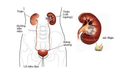 BỆNH SỎI THẬN Ở NGƯỜI LỚN