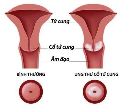 LÀM SAO ĐỂ TRÁNH KHÔNG BỊ MẮC UNG THƯ CỔ TỬ CUNG?