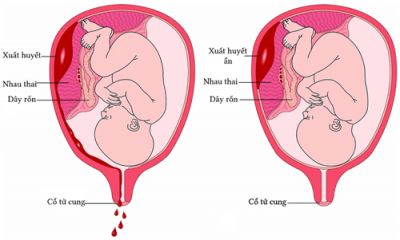 CẤP CỨU THÀNH CÔNG TRƯỜNG HỢP SẢN PHỤ BỊ NHAU BONG NON DO TAI NẠN, CỨU SỐNG CẢ MẸ VÀ BÉ