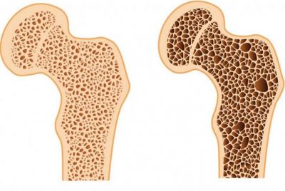 ĐO MẬT ĐỘ XƯƠNG BẰNG DEXA: BƯỚC QUAN TRỌNG ĐỂ BẢO VỆ XƯƠNG KHỚP