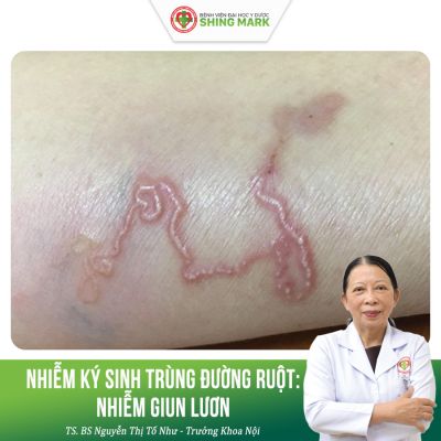 NHIỄM KÝ SINH TRÙNG ĐƯỜNG RUỘT: NHIỄM GIUN LƯƠN