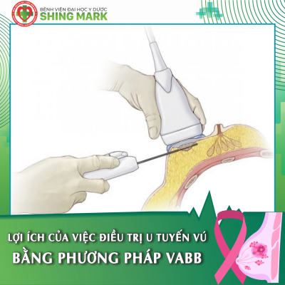 LỢI ÍCH CỦA VIỆC ĐIỀU TRỊ U TUYẾN VÚ BẰNG PHƯƠNG PHÁP VABB