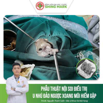 PHẪU THUẬT NỘI SOI ĐIỀU TRỊ U NHÚ ĐẢO NGƯỢC XOANG MŨI HIẾM GẶP