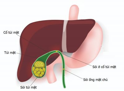 PHẪU THUẬT LẤY HƠN 50 VIÊN SỎI TRONG TÚI MẬT CHO NGƯỜI BỆNH TRẺ