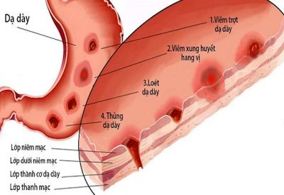 THỦNG DẠ DÀY Ở NGƯỜI TRẺ