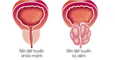 MRI TUYẾN TIỀN LIỆT: CÔNG CỤ QUAN TRỌNG TRONG CHẨN ĐOÁN UNG THƯ VÀ CÁC BỆNH LÝ LIÊN QUAN