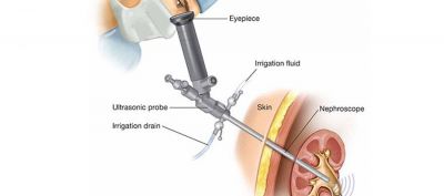 TÁN SỎI THẬN QUA DA BẰNG ĐƯỜNG HẦM NHỎ (MINI – PCNL)